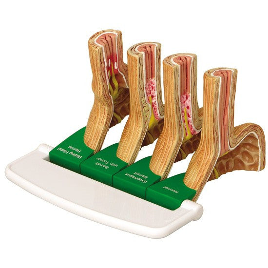 Gastro-oesophageal Reflux Disease (GERD) Model - 2010