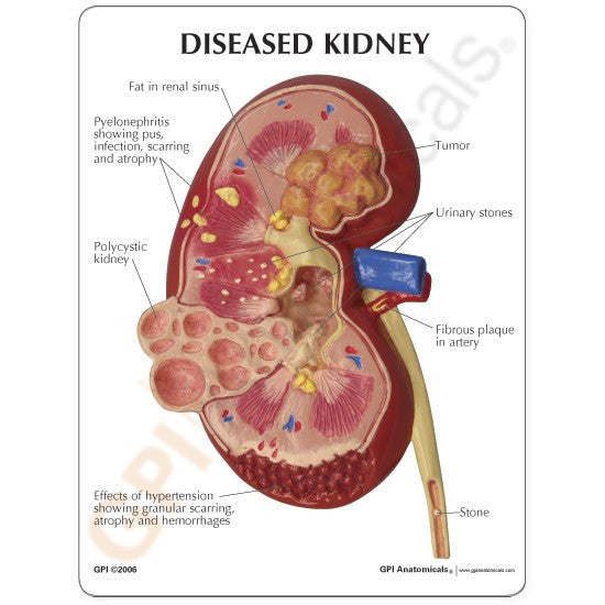 Normal / Diseased Kidney Model