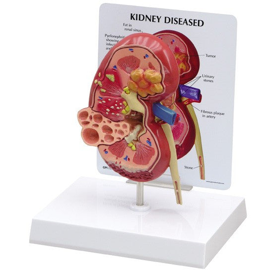 Normal / Diseased Kidney Model