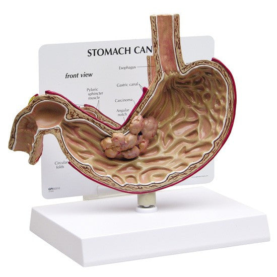 Stomach Cancer Model