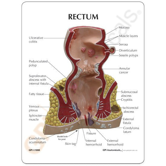 Rectum Pathologies Model