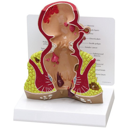 Rectum Pathologies Model