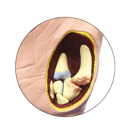 Osteoarthritis (OA) Hand Model