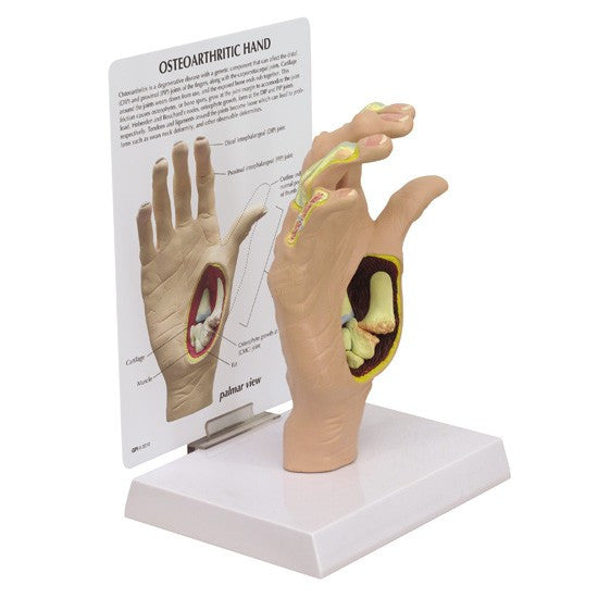 Osteoarthritis (OA) Hand Model