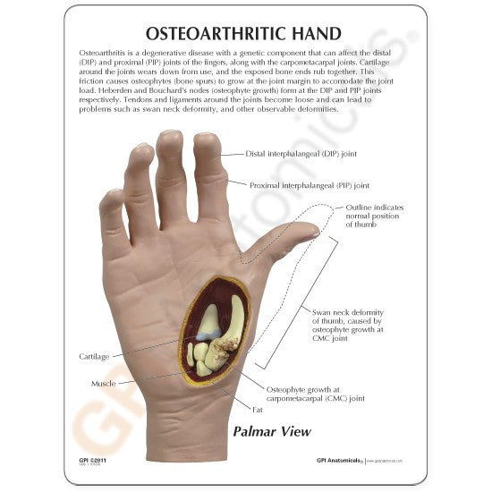 Osteoarthritis (OA) Hand Model