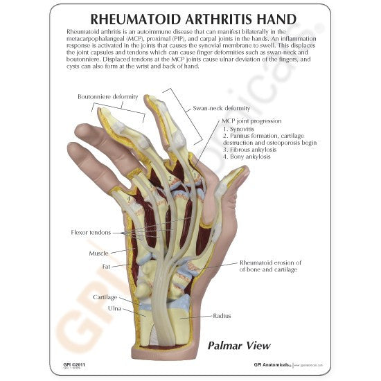 Rheumatoid Arthritis (RA) Hand Model