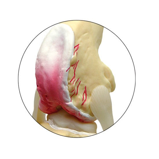 4-Stage Knee Model Set demonstrates degenerative joint disease