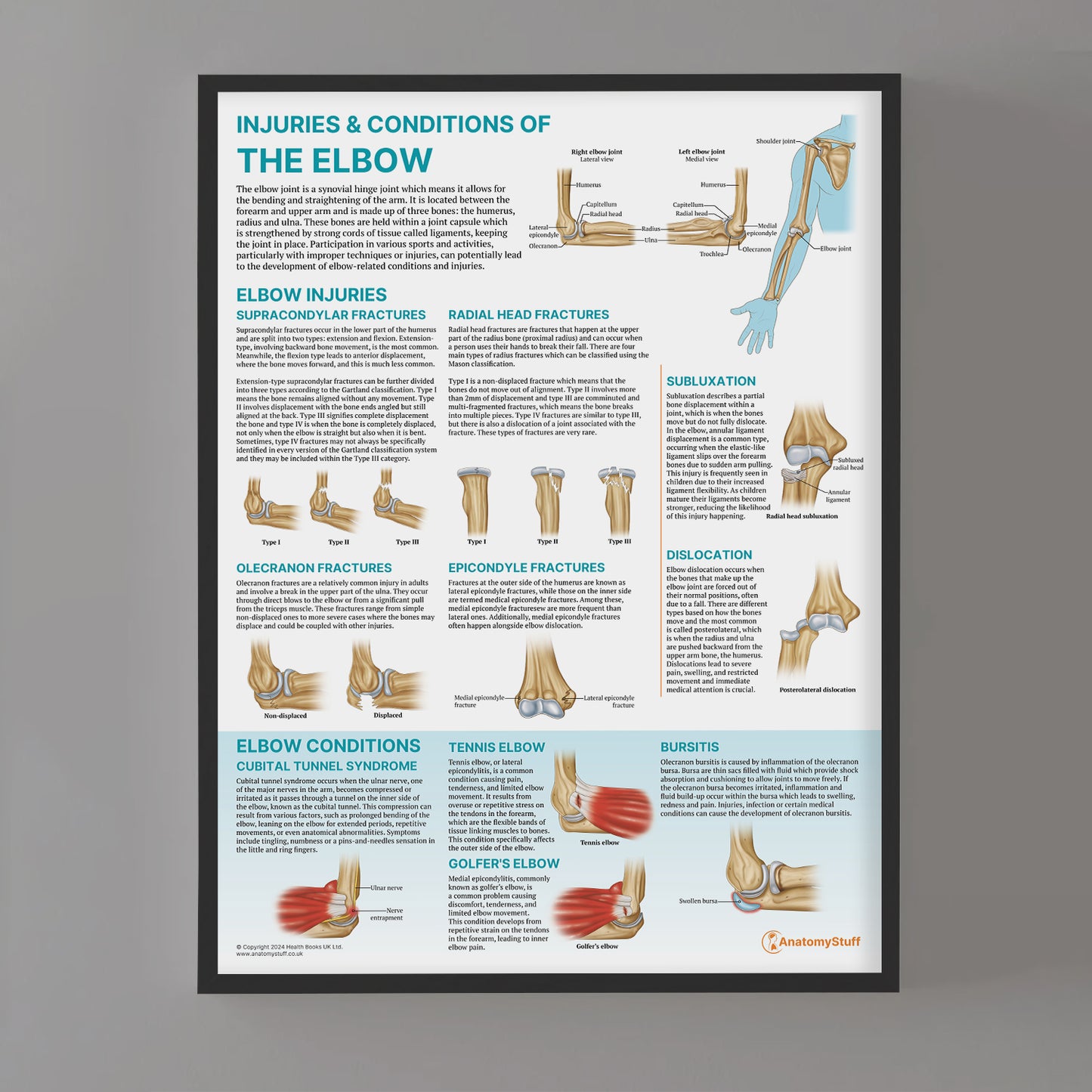 Injuries & Conditions of the Elbow Chart / Poster