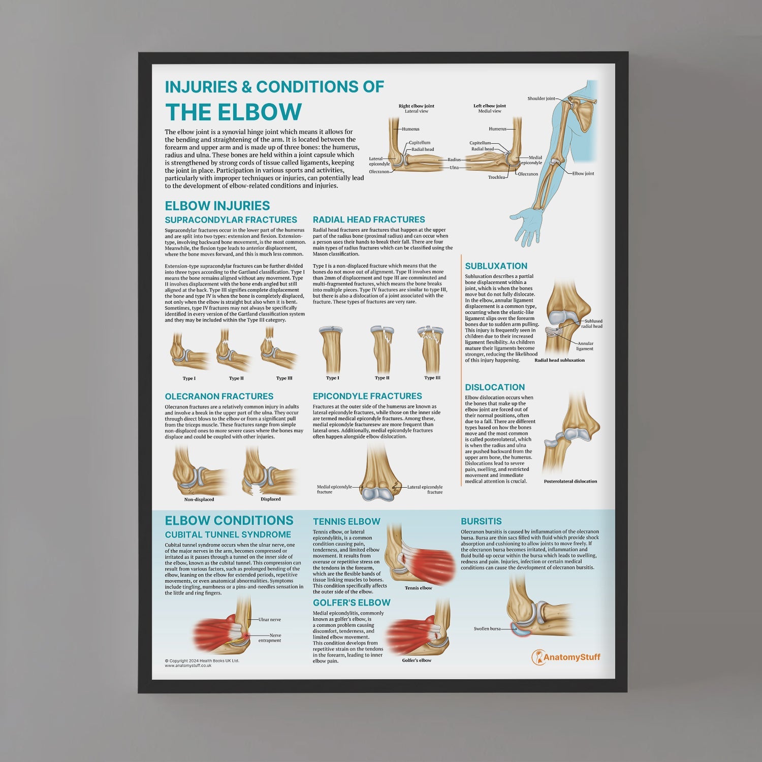 Injuries & Conditions of the Elbow Chart / Poster - Part of Collection