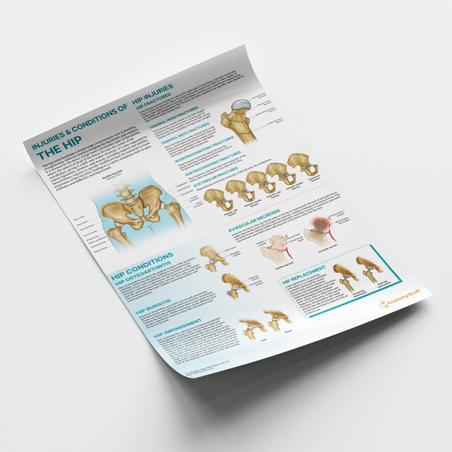Injuries & Conditions of the Hip Chart / Poster