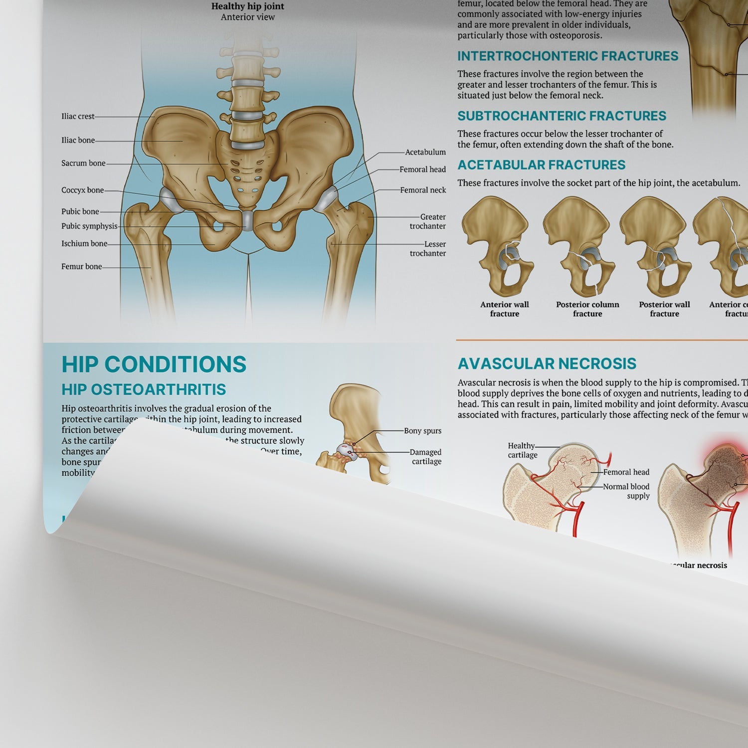 Injuries & Conditions of the Hip Chart / Poster - Part of Collection
