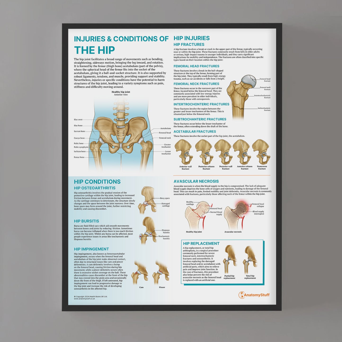 Injuries & Conditions of the Hip Chart / Poster