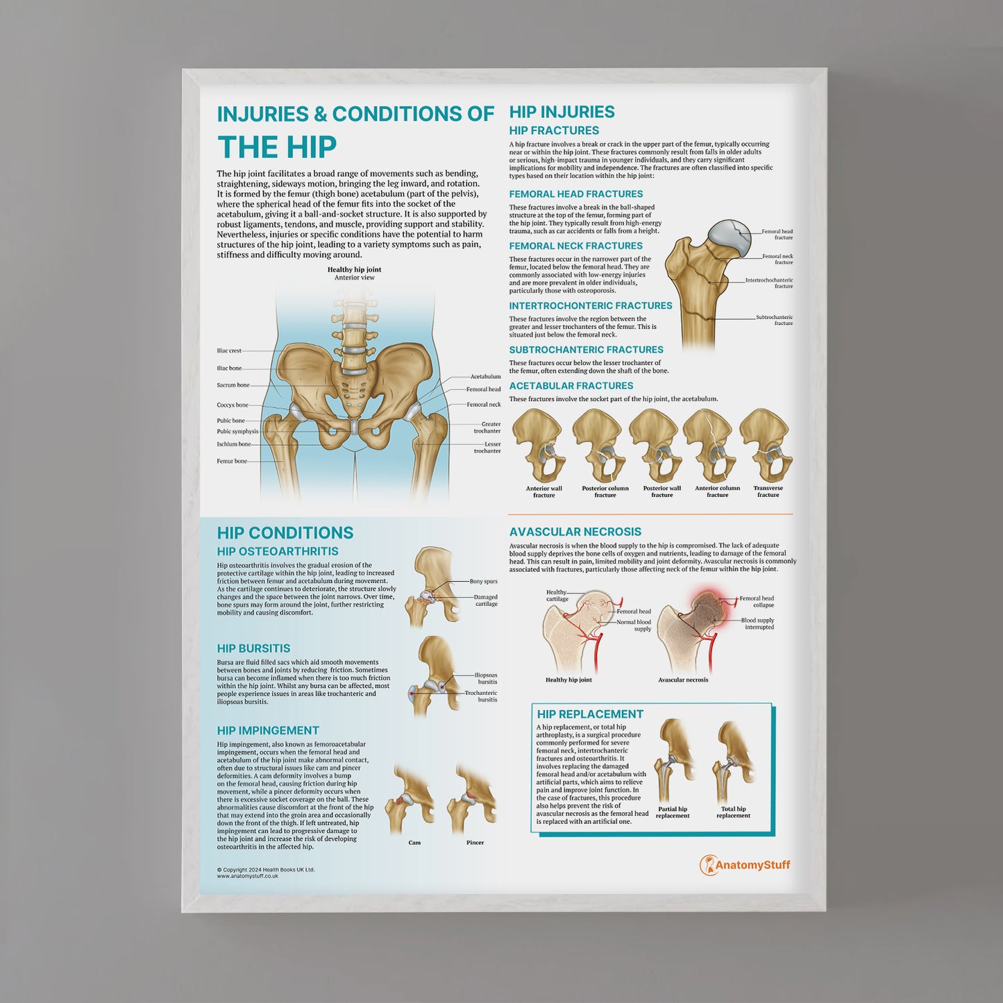 Injuries & Conditions of the Hip Chart / Poster