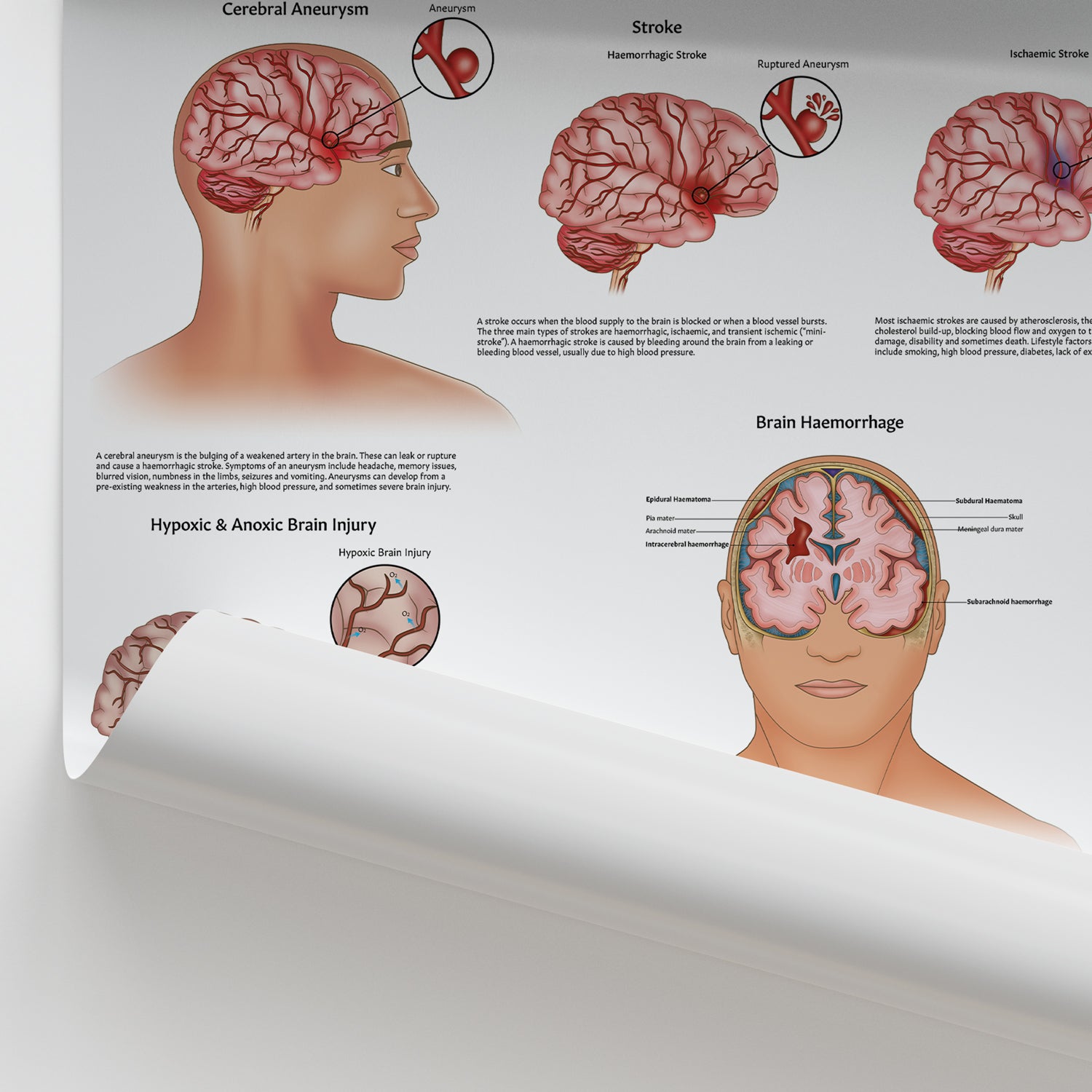 Injuries Of The Brain Chart / Poster