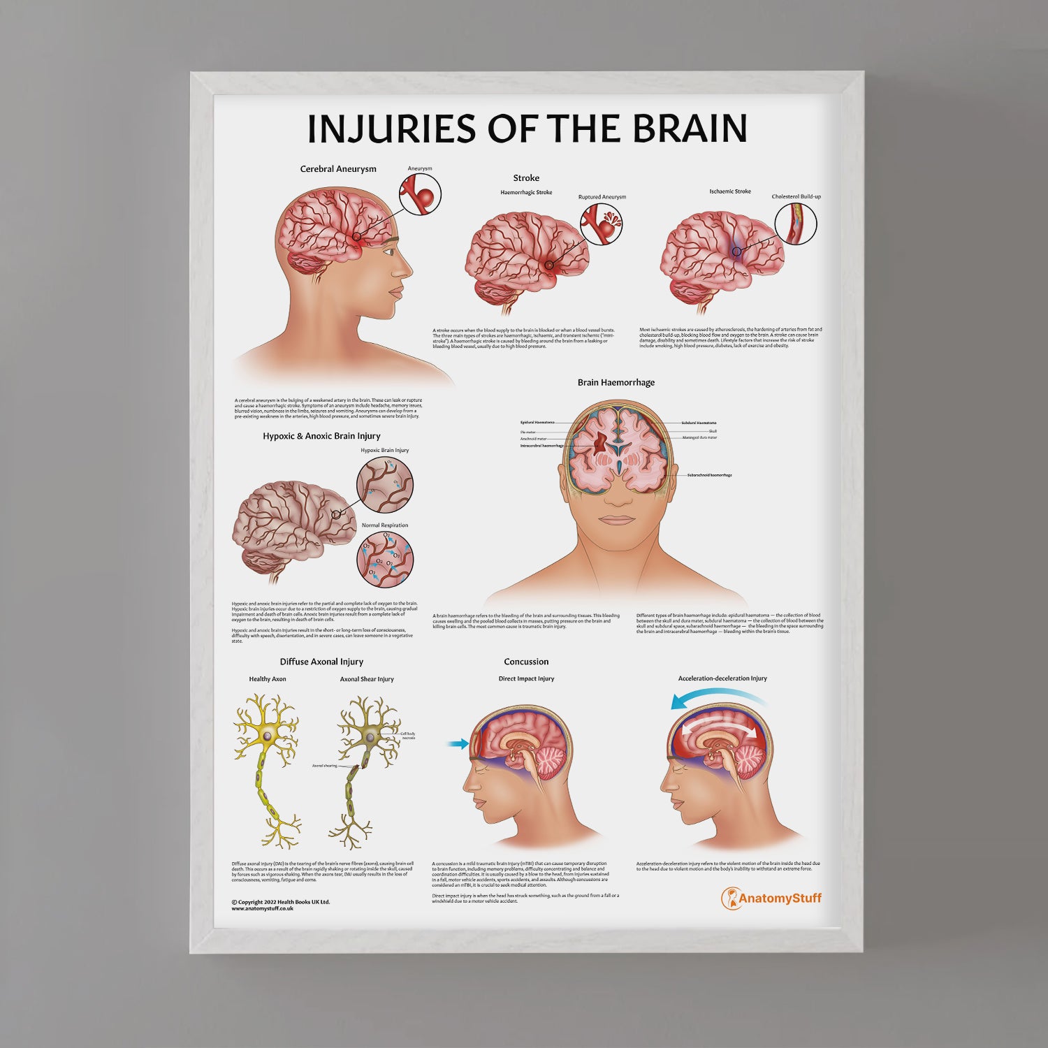 Injuries Of The Brain Chart / Poster
