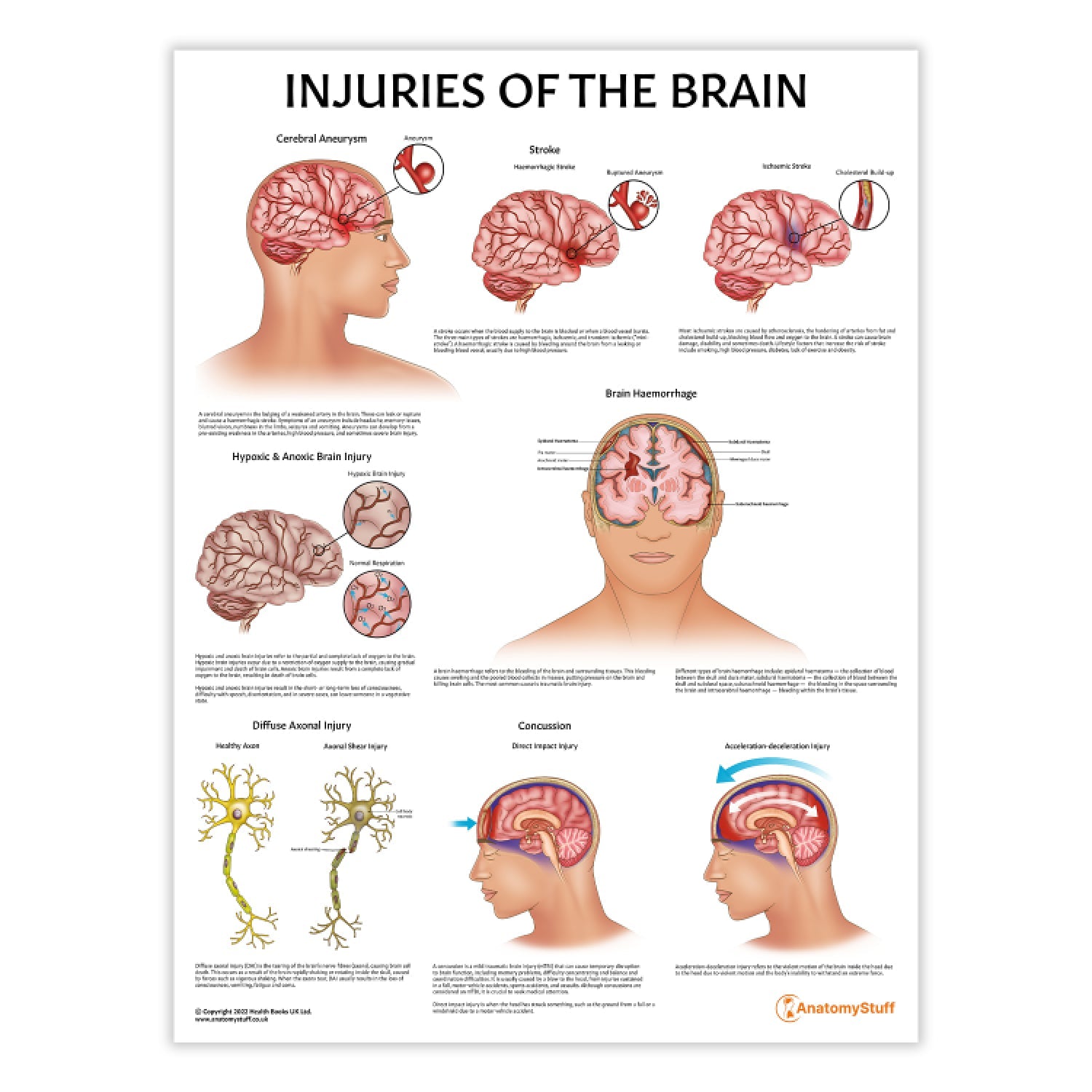 Injuries Of The Brain Chart / Poster - Part of Collection