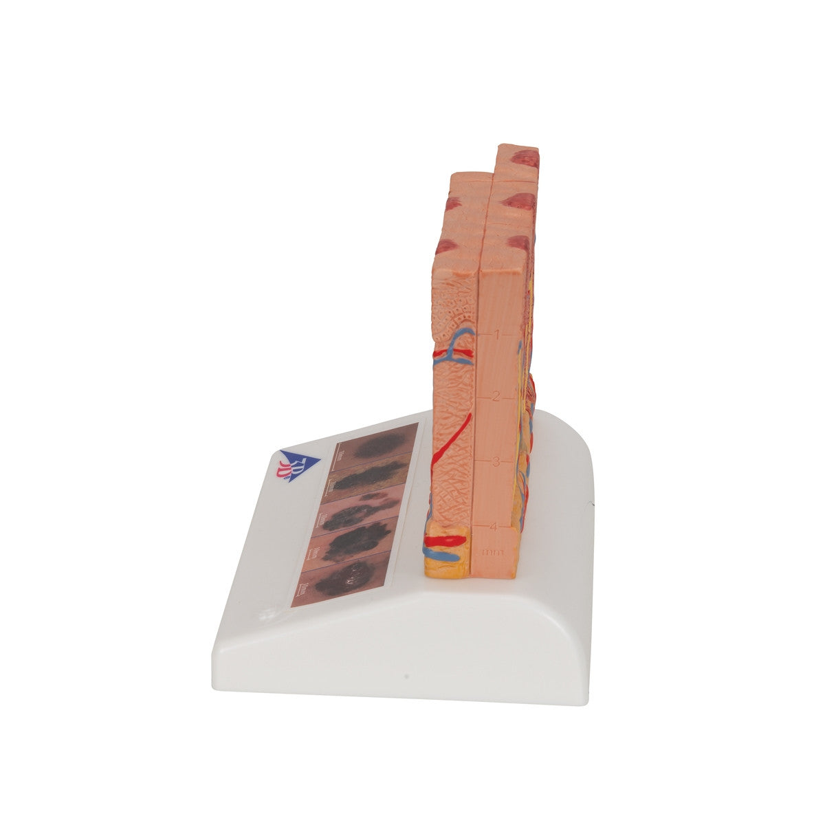 Skin Cancer Model (8 times life size)