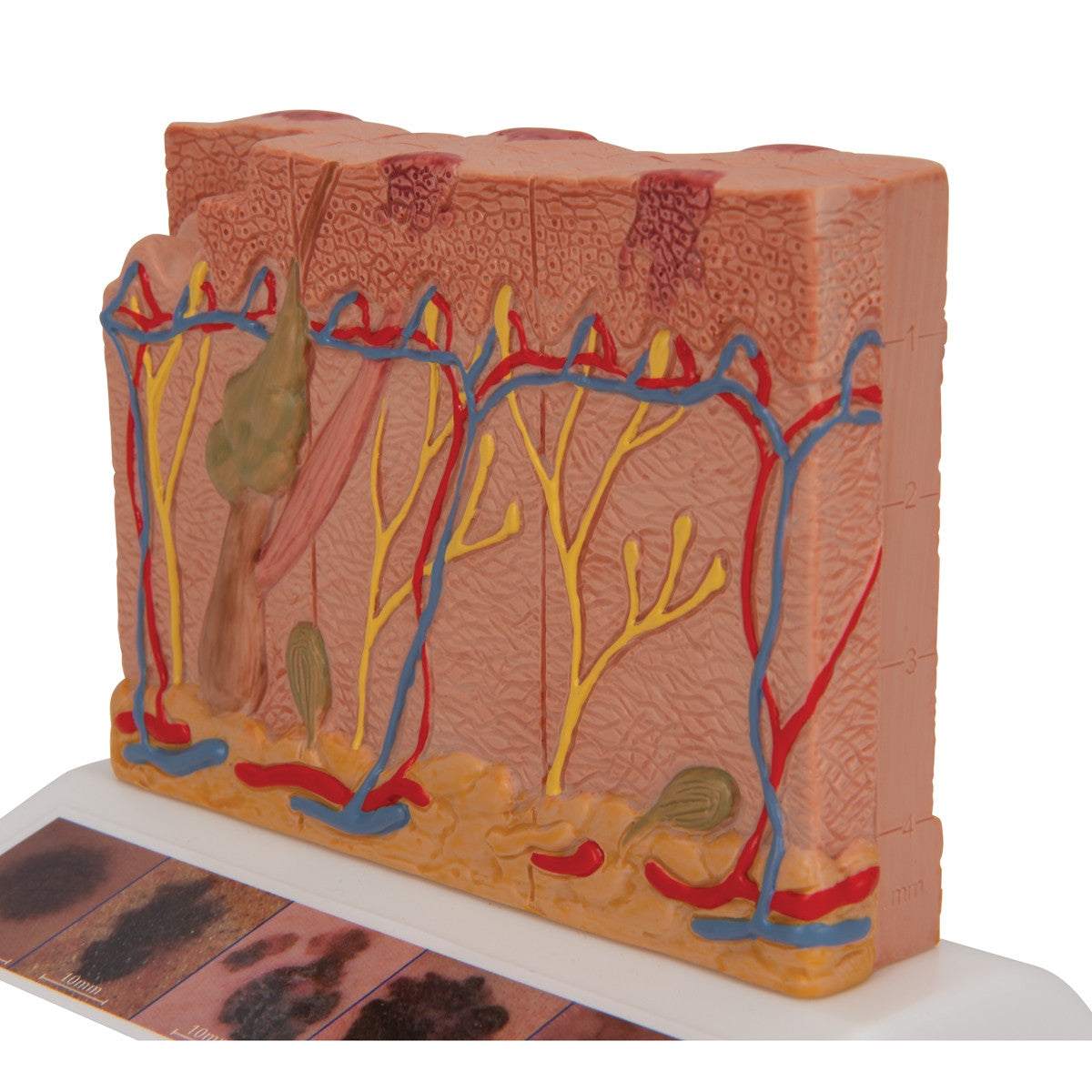 Skin Cancer Model (8 times life size)
