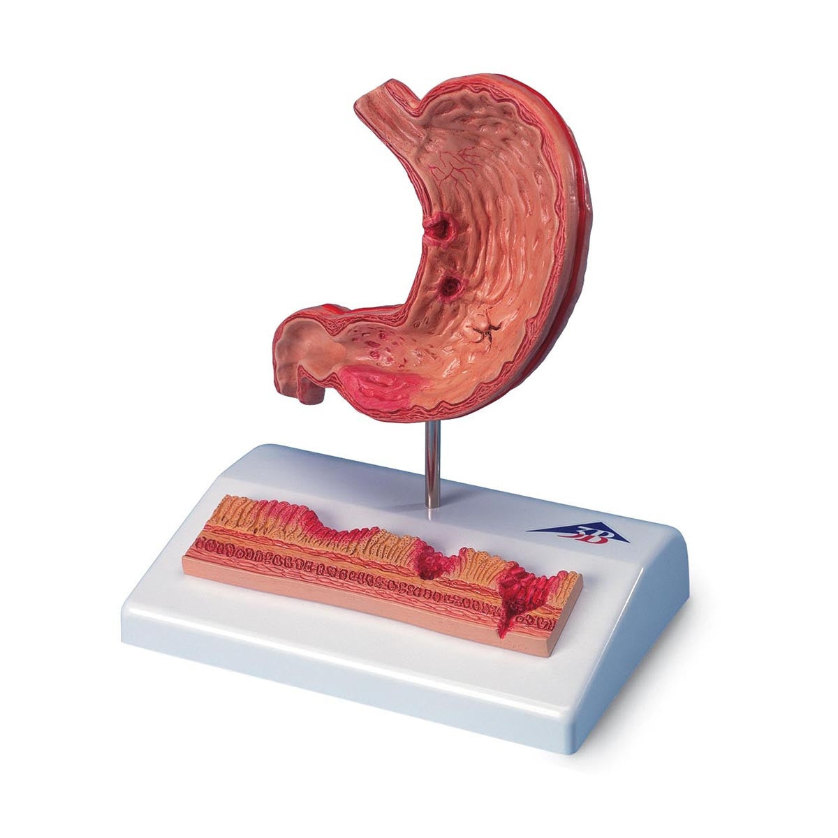 Stomach Model With Ulcers