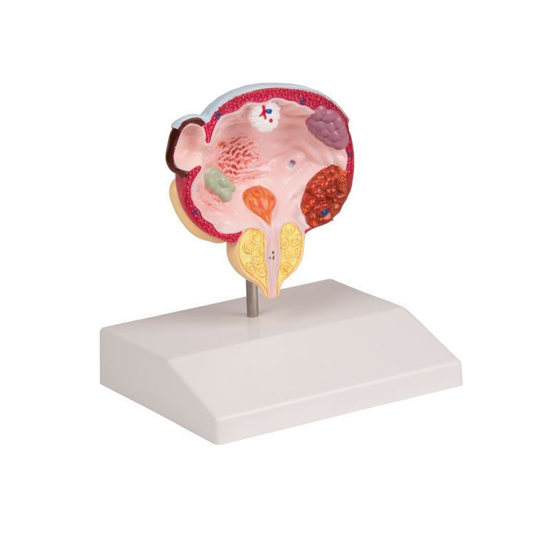 Diseases of the Bladder and Prostate Model