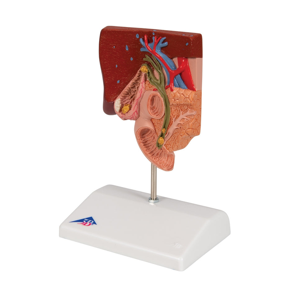 Gallstone Anatomical Model