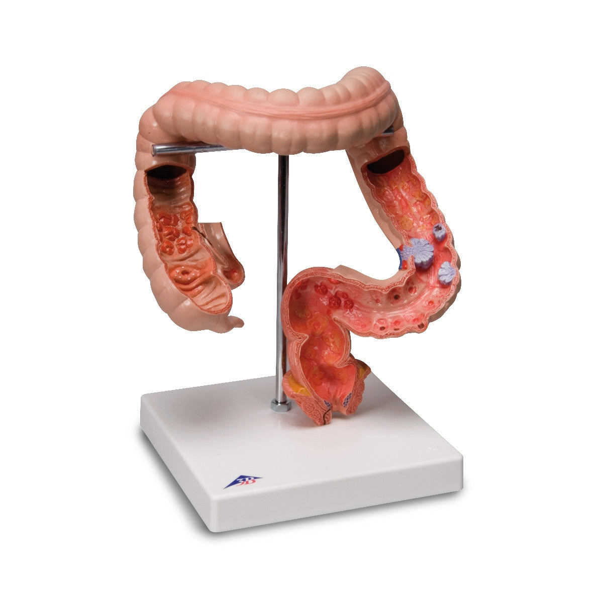 Intestinal Diseases Model 1008496
