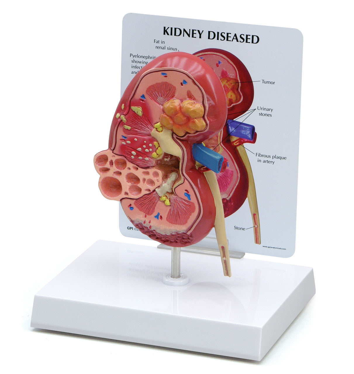 Diseased Kidney Model and Chart
