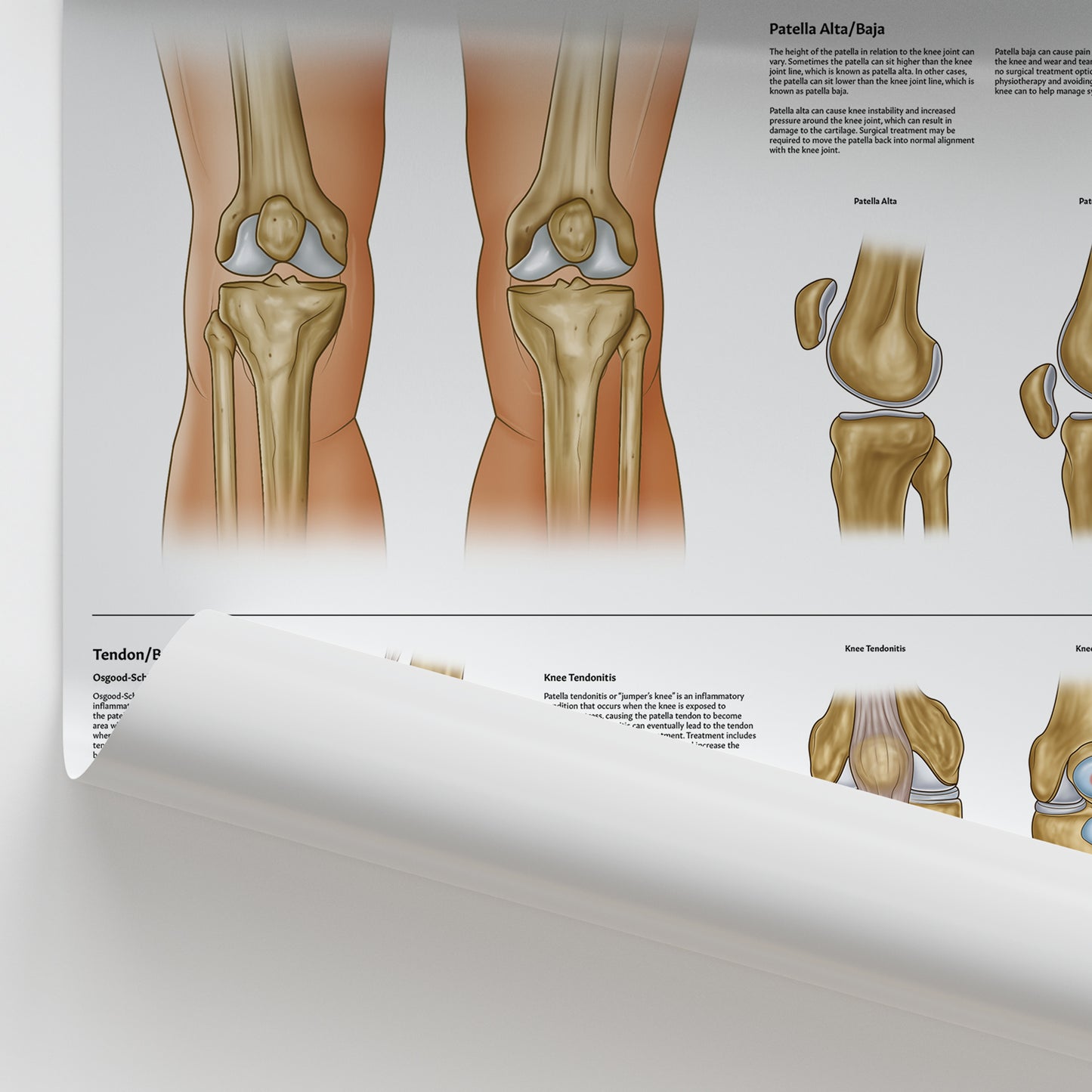 Knee Conditions Chart / Poster