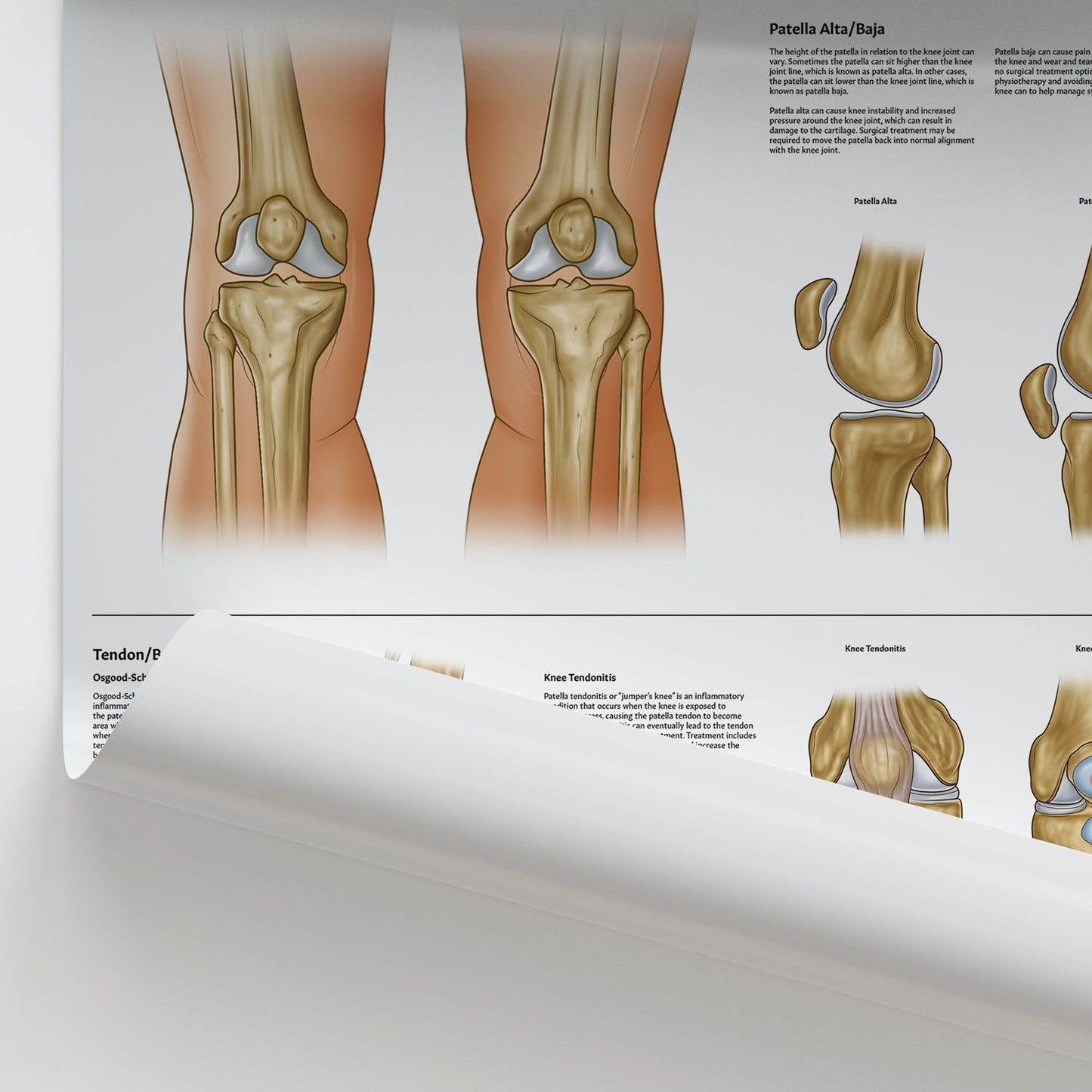 Knee Conditions Chart / Poster