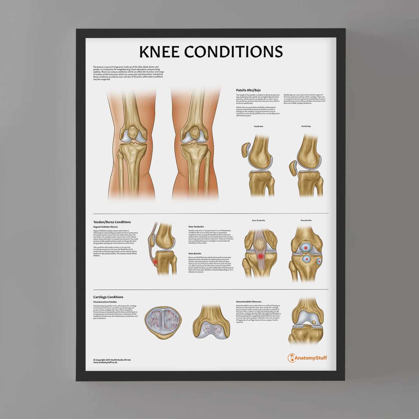 Knee Conditions Chart / Poster