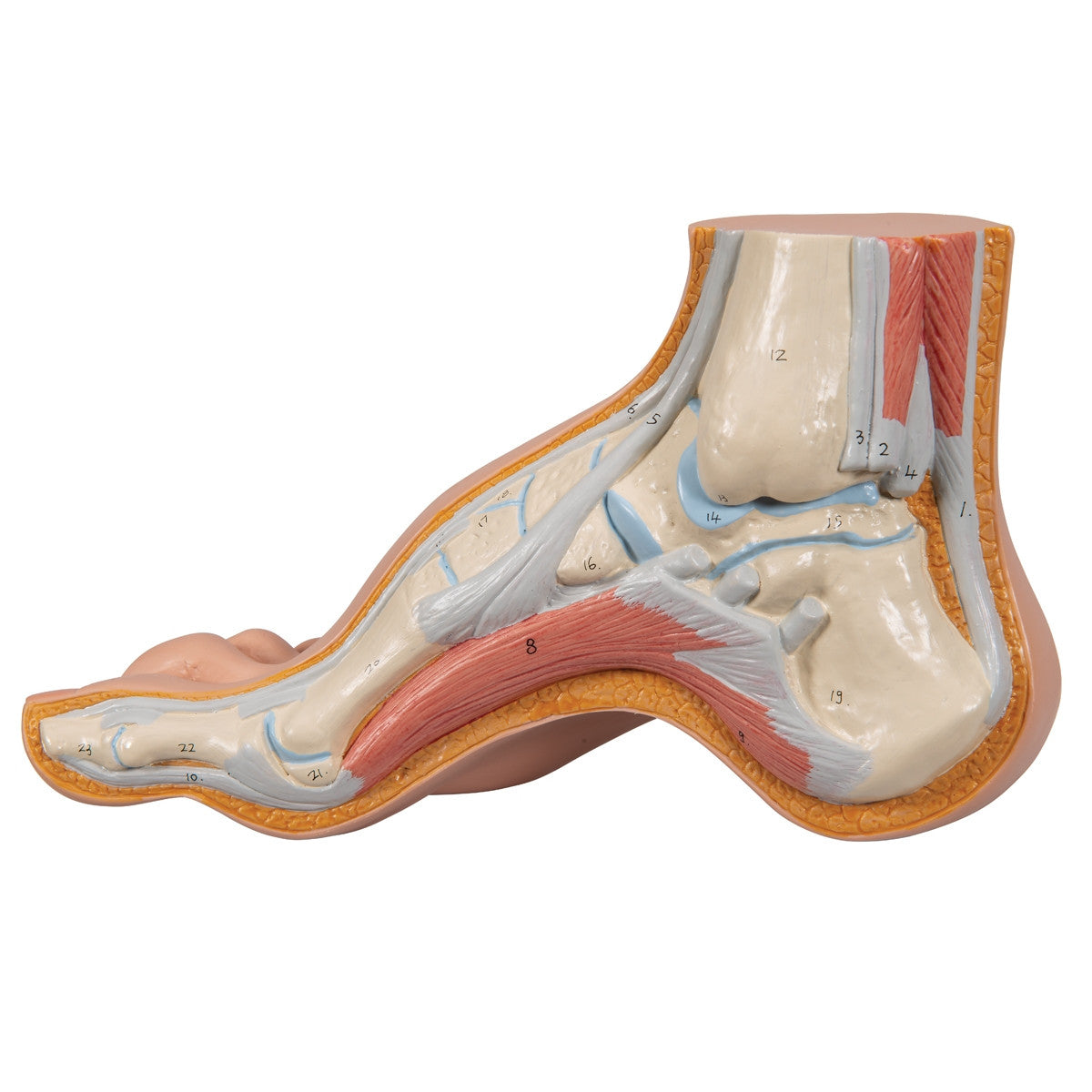 Hollow Foot Model (Pes Cavus)