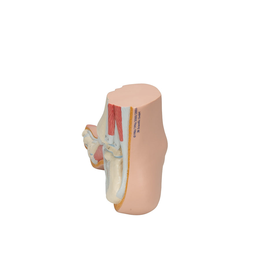 Hollow Foot Model (Pes Cavus)