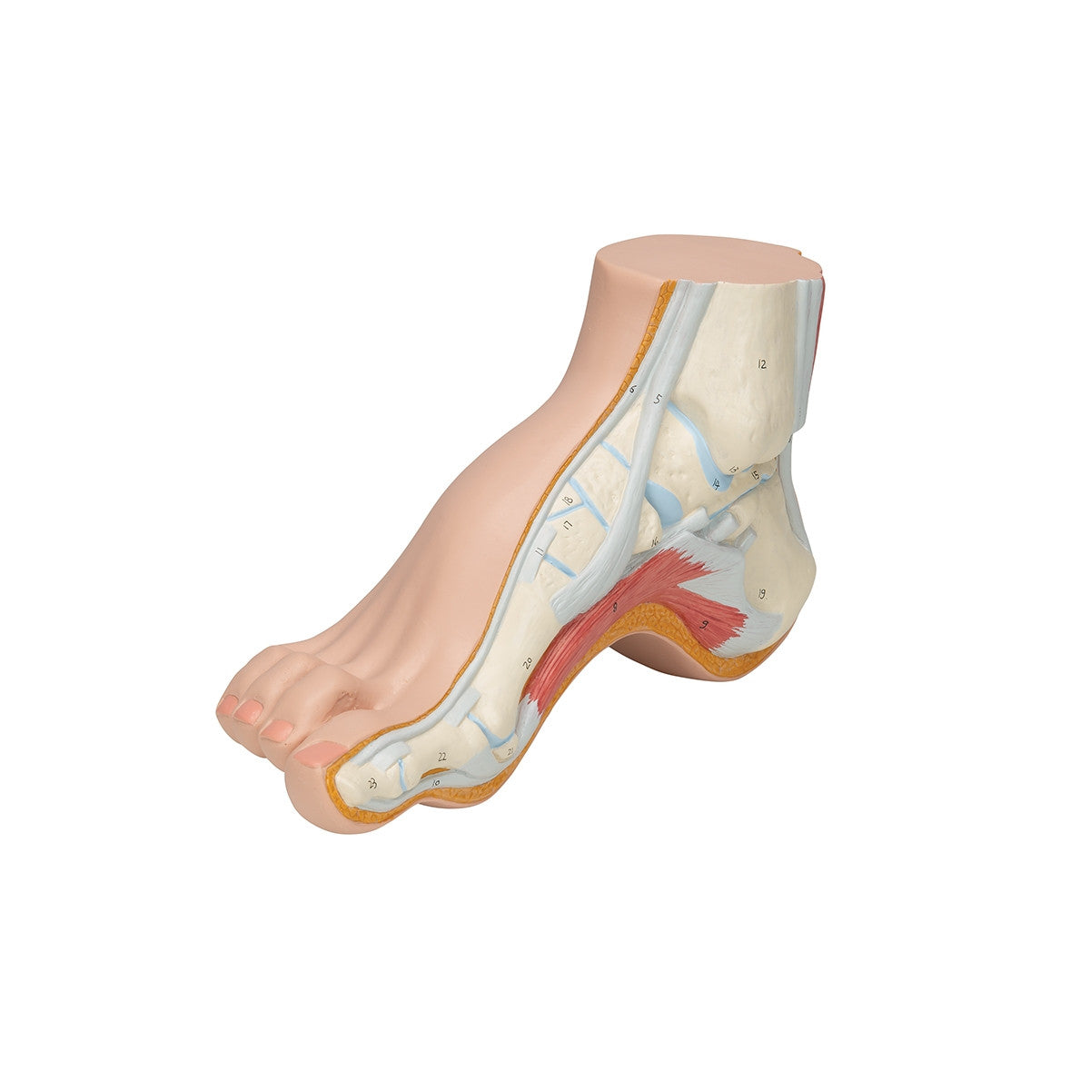Hollow Foot Model (Pes Cavus)