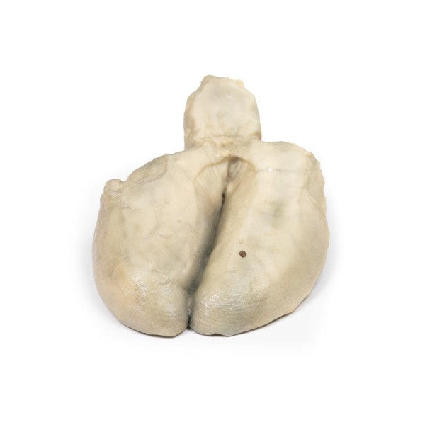 Cholelithiasis (Gallstones) 3D Printed Anatomy Model