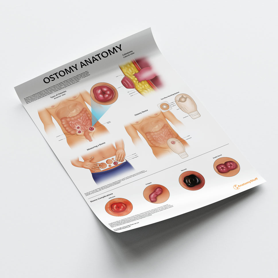 Ostomy Anatomy Chart / Poster