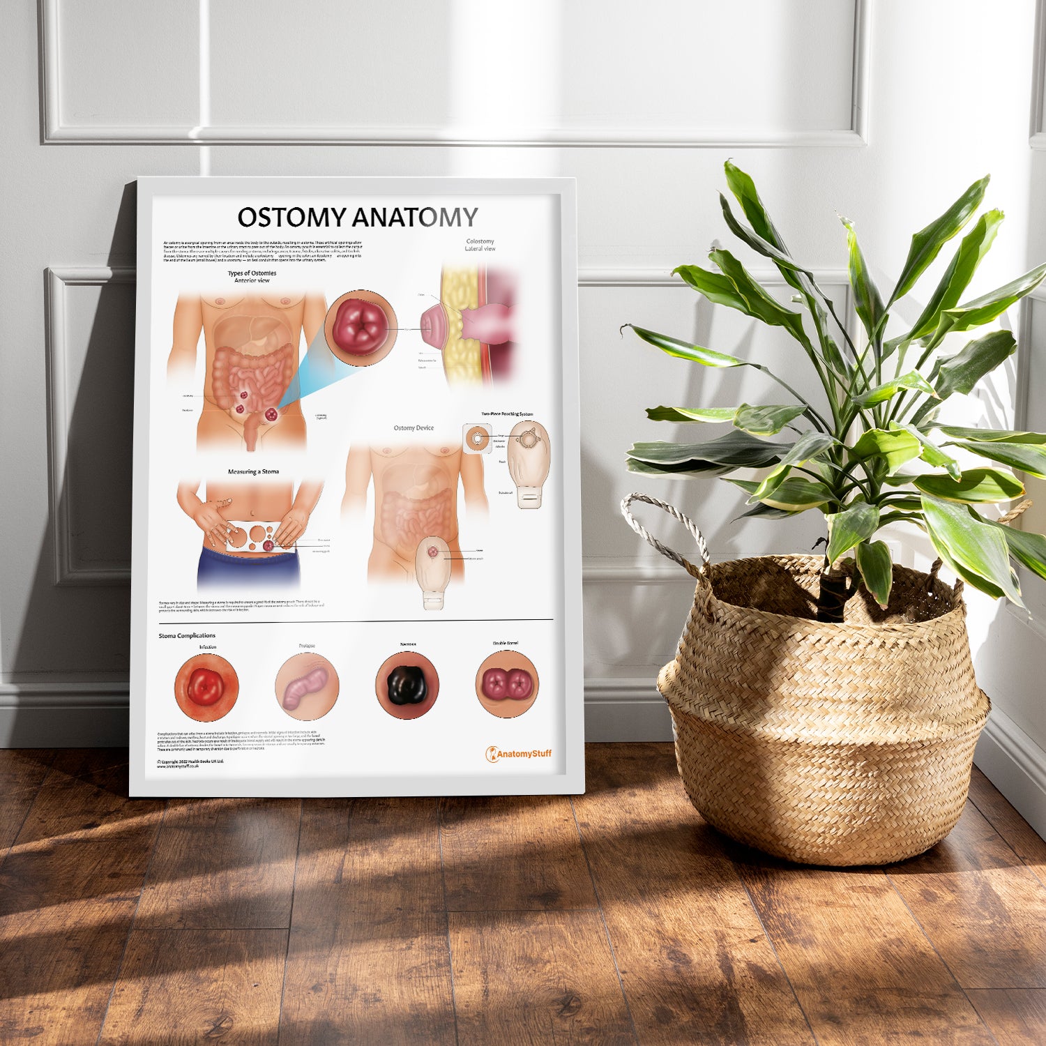 Ostomy Anatomy Chart / Poster