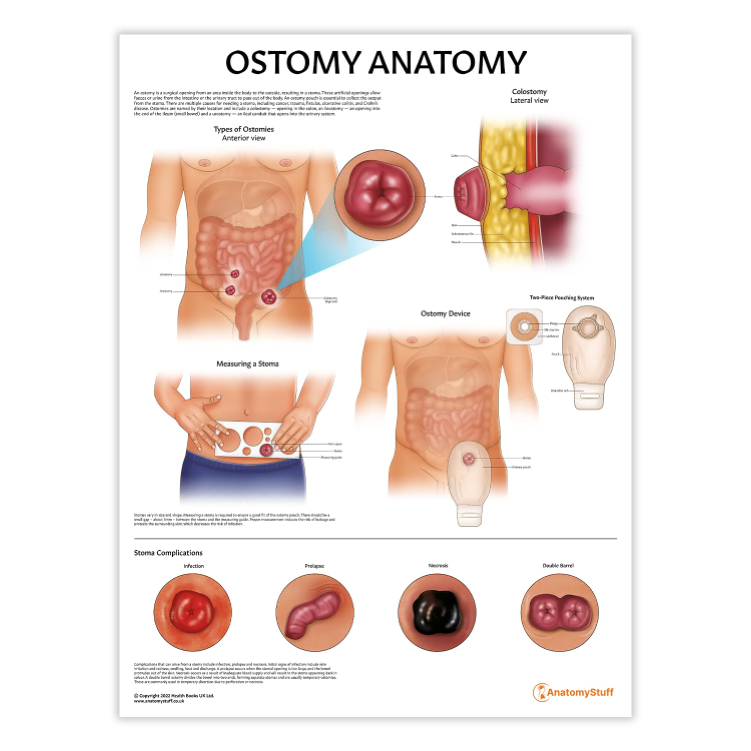 Ostomy Anatomy Chart / Poster