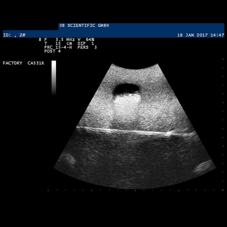 SONOtrain Ultrasound Vein Model