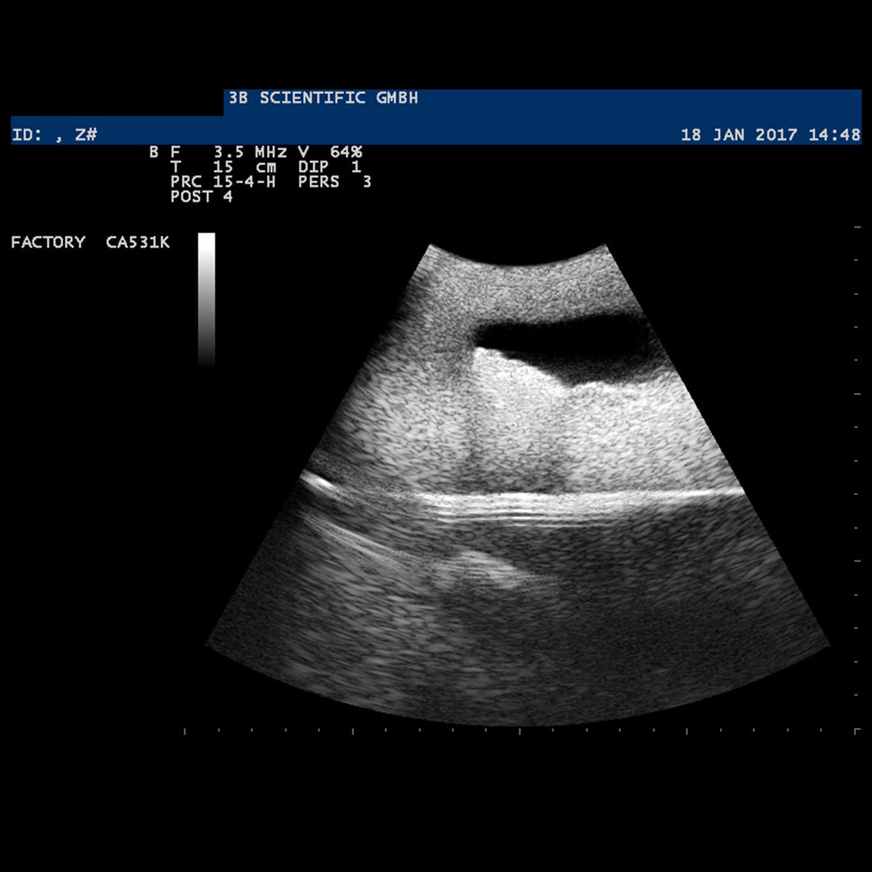 SONOtrain Ultrasound Vein Model