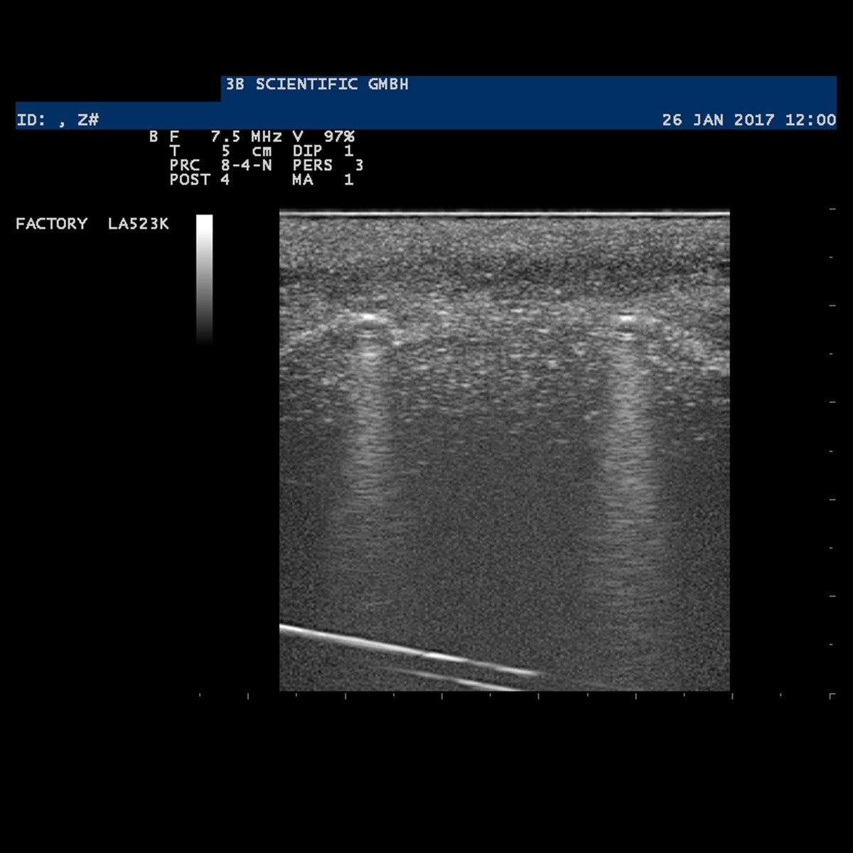 SONOtrain Ultrasound Foreign Body Model