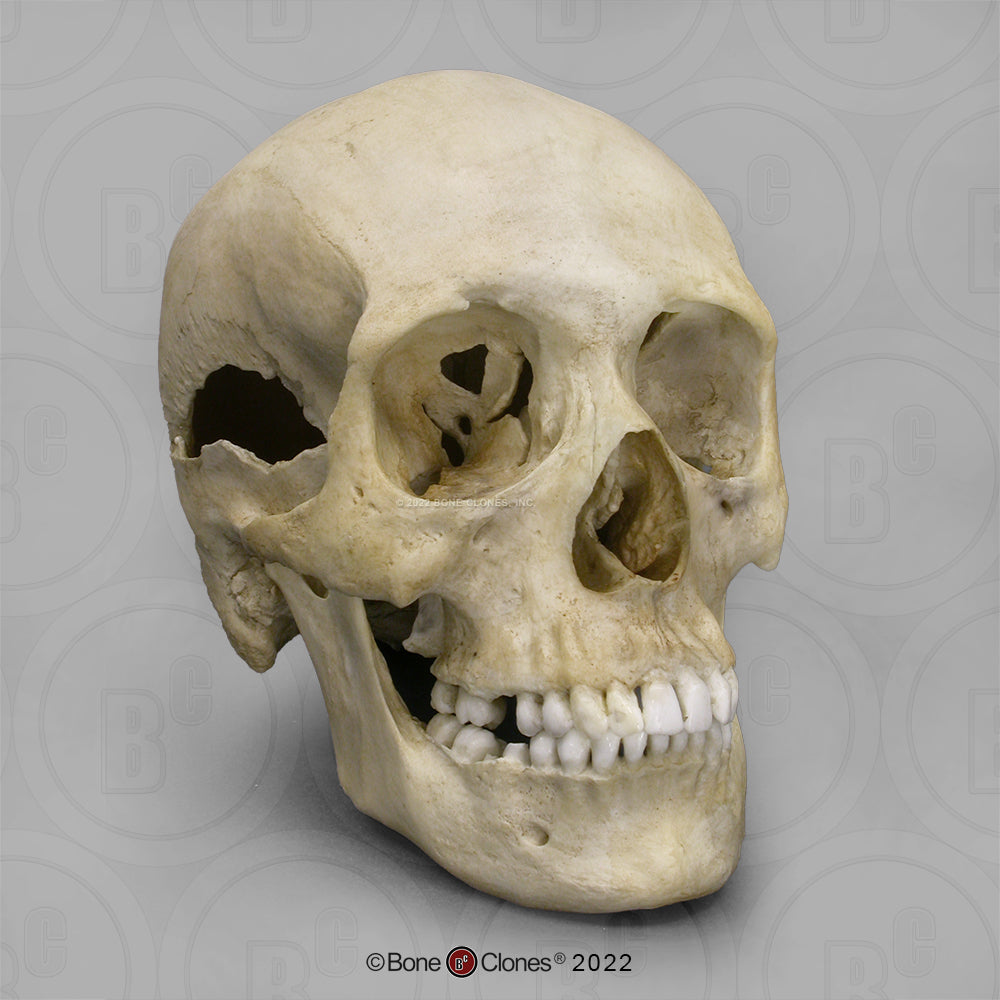 Bone Clones Forensic Trauma Skulls