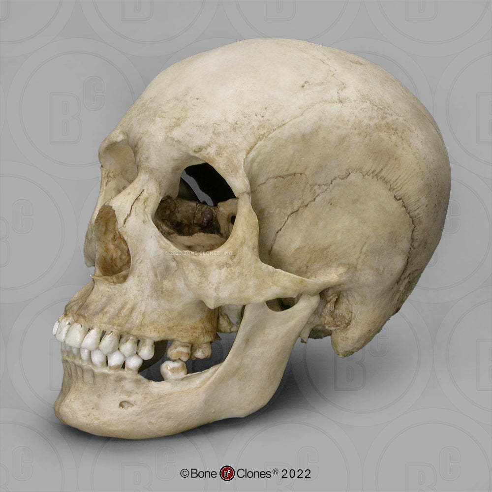 Bone Clones Forensic Trauma Skulls