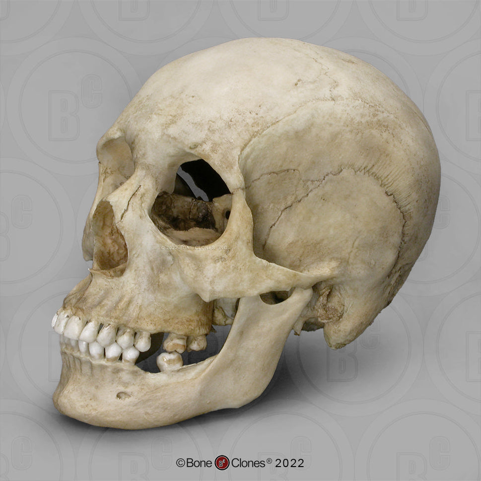 Bone Clones Forensic Trauma Skulls