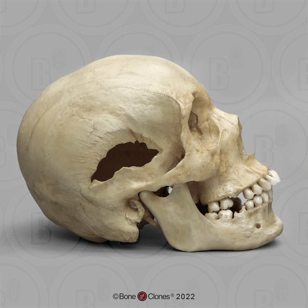 Bone Clones Forensic Trauma Skulls