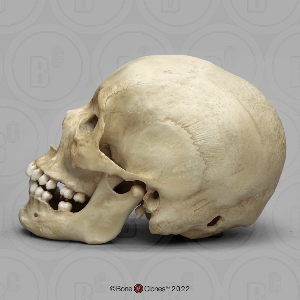 Bone Clones Forensic Trauma Skulls