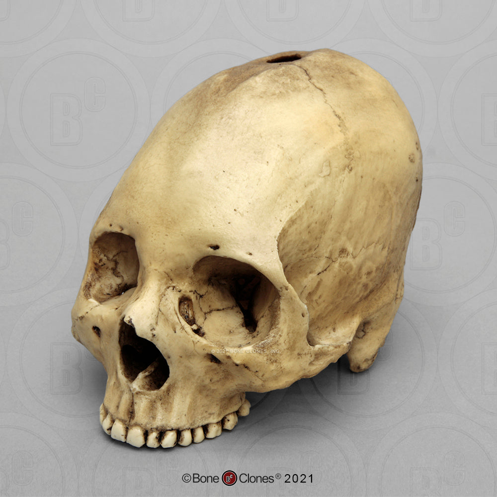Bone Clones Forensic Trauma Skulls