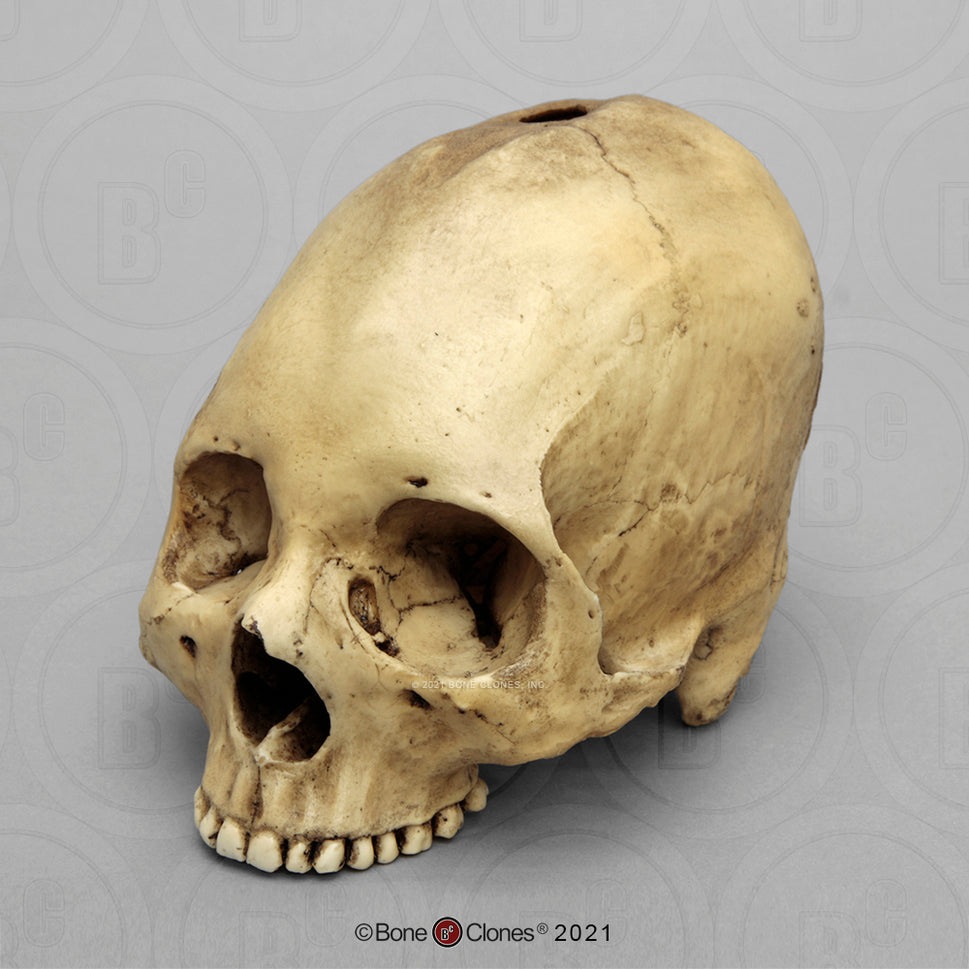 Bone Clones Forensic Trauma Skulls