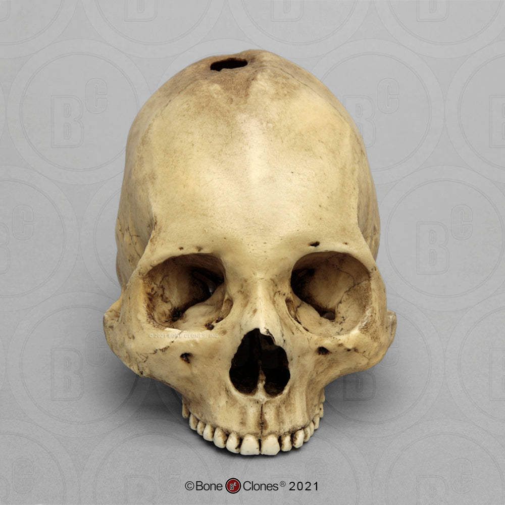 Bone Clones Forensic Trauma Skulls