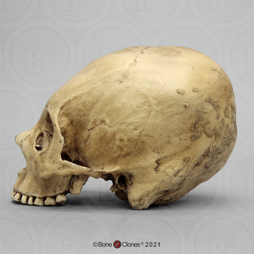 Bone Clones Forensic Trauma Skulls