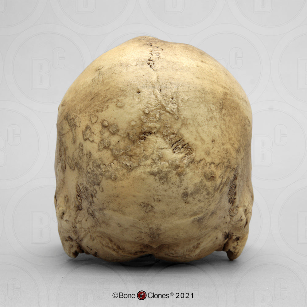 Bone Clones Forensic Trauma Skulls